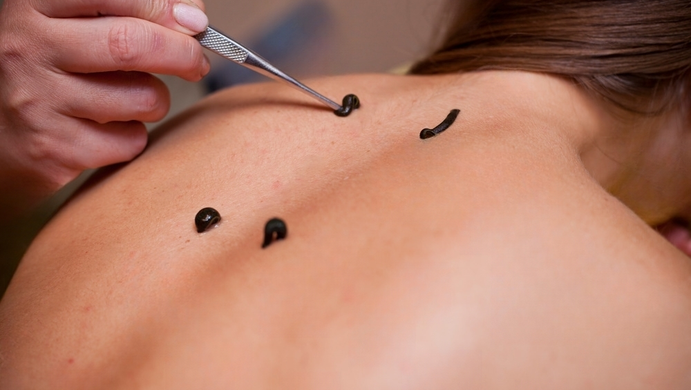 Leech Therapy in Kerala | Ayurvedic treatment hospital in Kottakkal, Kerala, India