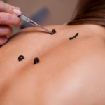 Leech Therapy in Kerala | Ayurvedic treatment hospital in Kottakkal, Kerala, India