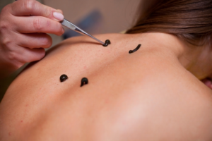 Leech Therapy in Kerala | Ayurvedic treatment hospital in Kottakkal, Kerala, India
